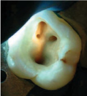 Molar superior