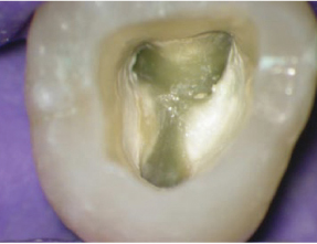 Molar superior