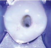 premolar inferior