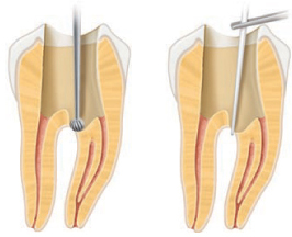 Molar inferior