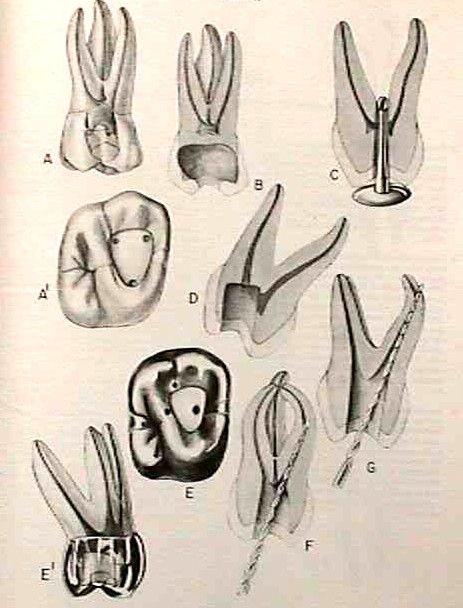 Errores molares superiores