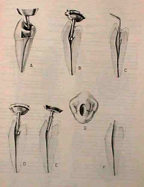 Premolar inferior