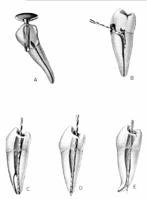 Errores premolar inferior