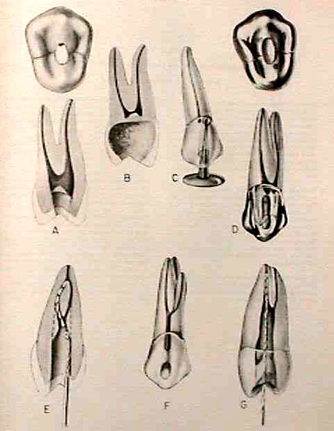 Errores premolar superior