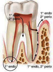 Endo-perio