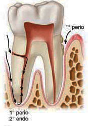Perio-endo