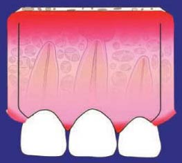 Incisión gingival