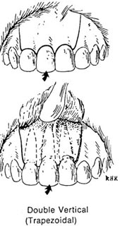 Incisión trapezoidal