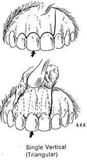 Incisión triangular