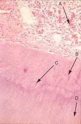 Dentina secundaria