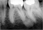 Osteitits condensante