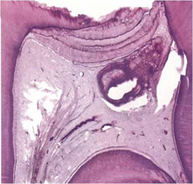 Absceso pulpar