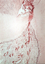 Pulpitis crónica